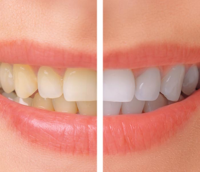 Close-up view of a woman's smile showing before and after Dental Veneers by S&L Dental in Paradise Valley, AZ