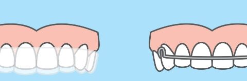 Comparing clear aligners vs. traditional aligners