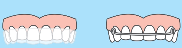 Comparing clear aligners vs. traditional aligners 