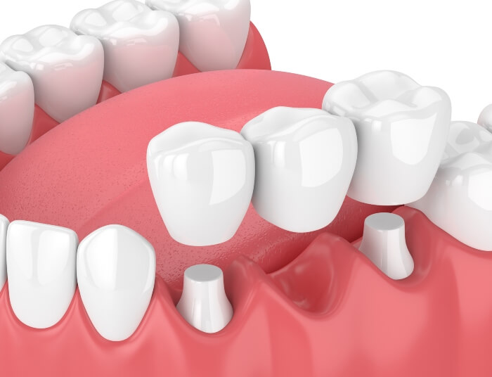 Dental Bridge Treatment at S&L Dental
