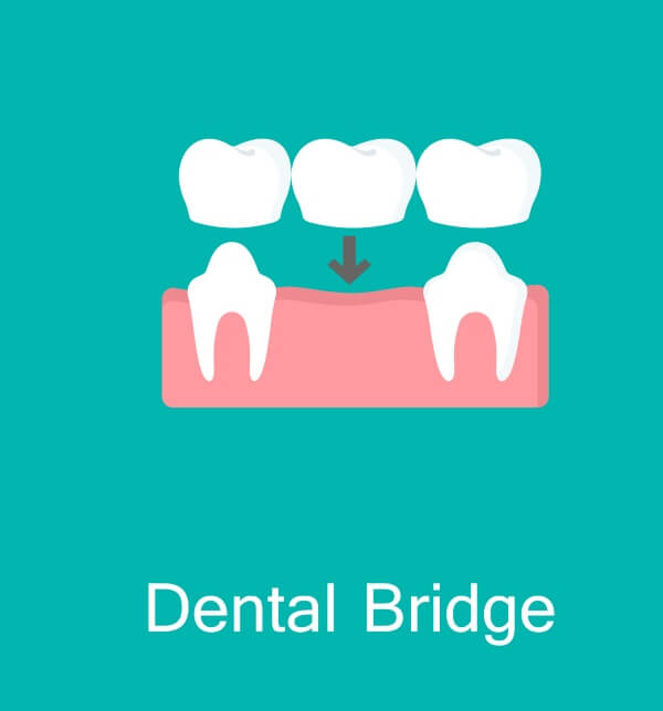Dental Bridges service at S&L Dental