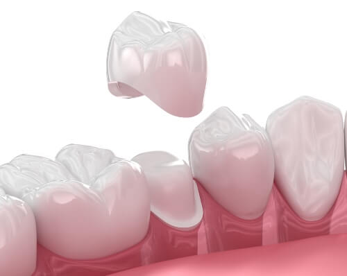 The Dental Crown Procedure: What to Expect The dental crown procedure is straightforward and typically completed in two visits. During the first visit, Dr. David Ngo, our expert dentist, will prepare your tooth by removing any decay and shaping it to fit the crown perfectly. An impression of your tooth is taken to create a custom crown that matches your natural teeth. You’ll receive a temporary crown to wear while your permanent one is being crafted. In your second visit, the temporary crown is removed, and the new, permanent crown is cemented in place. The result? A beautifully restored tooth that looks and functions just like your natural teeth.