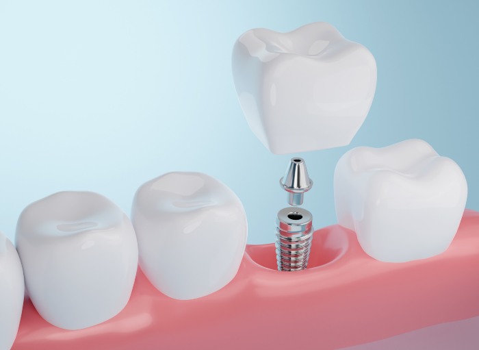 Dental Implant at S&L Dental in Paradise Valley, AZ