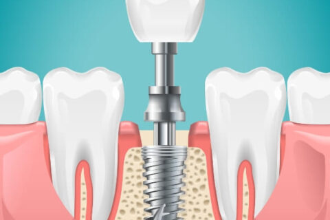 Illustration of Dental Implant at S&L Dental