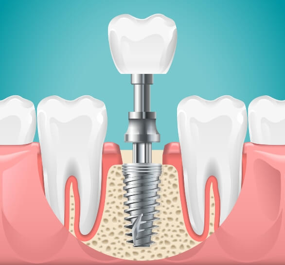 Illustration of Dental Implant at S&L Dental