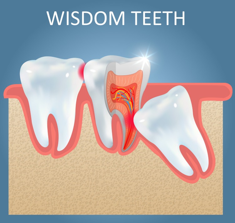 Wisdom teeth Removal service in Paradise Valley, AZ