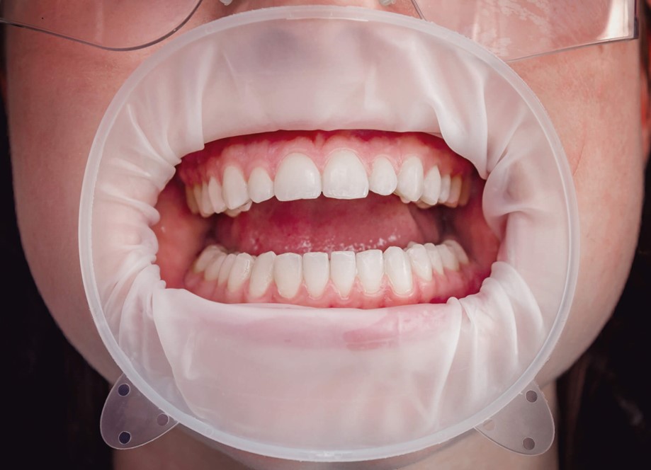 A person with a mouth guard displaying newly reconstructed teeth