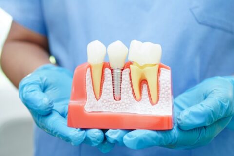 Dentist holding dental implant, artificial tooth roots into jaw