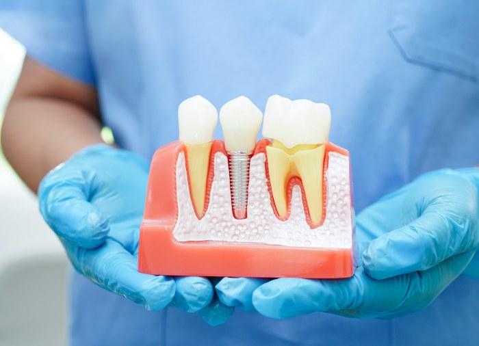 Dentist holding dental implant, artificial tooth roots into jaw