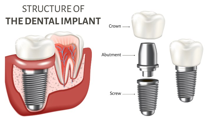 Educational structure of the dental implant - S&L Dental