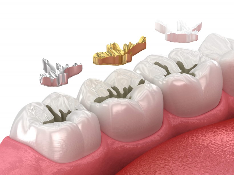 Illustration showing various types on dental inlays and overlays