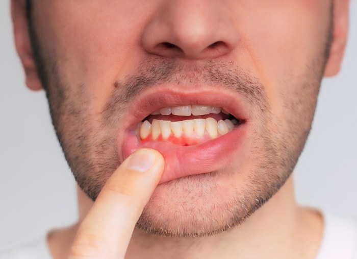 Young Man showing gum bleeding and inflammation - S&L Dental