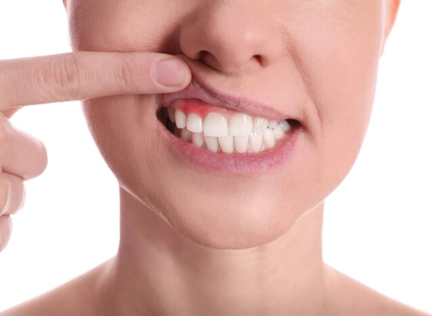 gum treatment with laser periodontal