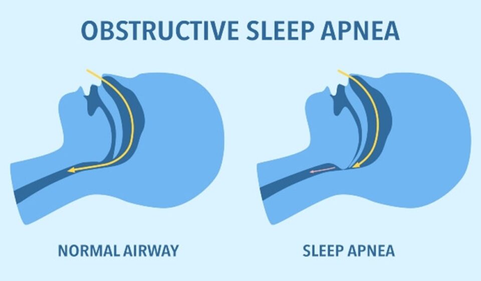 obstructive sleep apnea