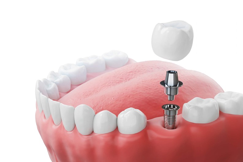 A model of a human teeth with dental implant hardware displayed