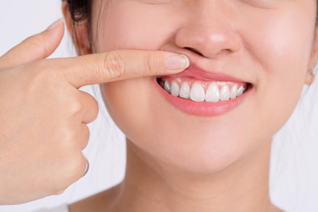 A person holding their lip to expose teeth and gums
