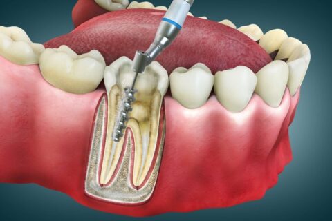 Diagram of a root canal