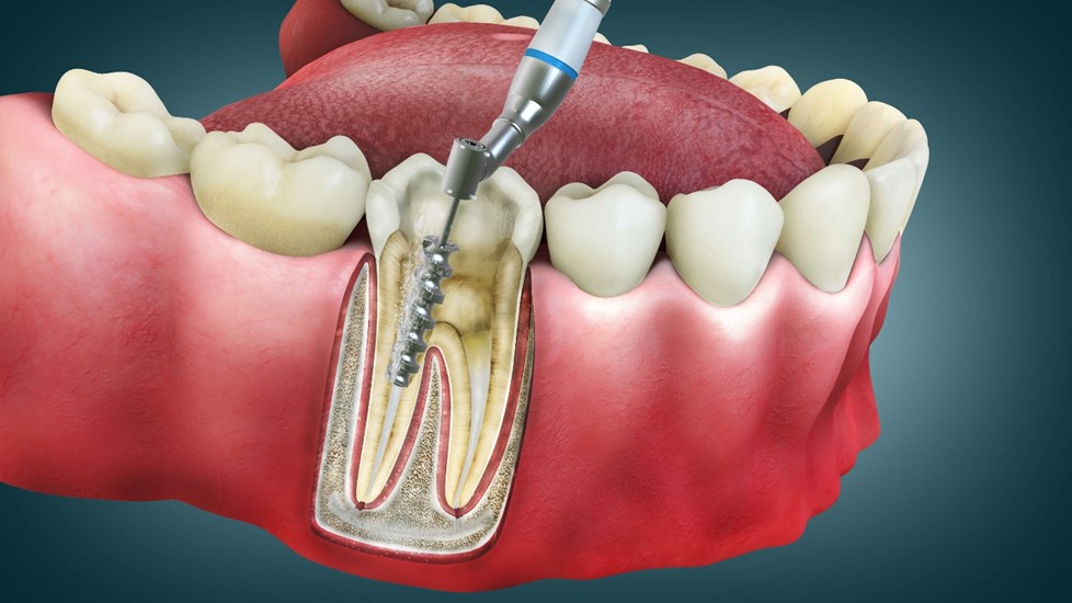 Diagram of a root canal